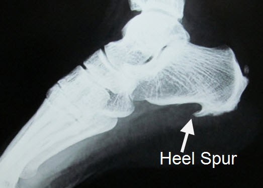 Heel Spur Pain Physical Therapy Bozeman