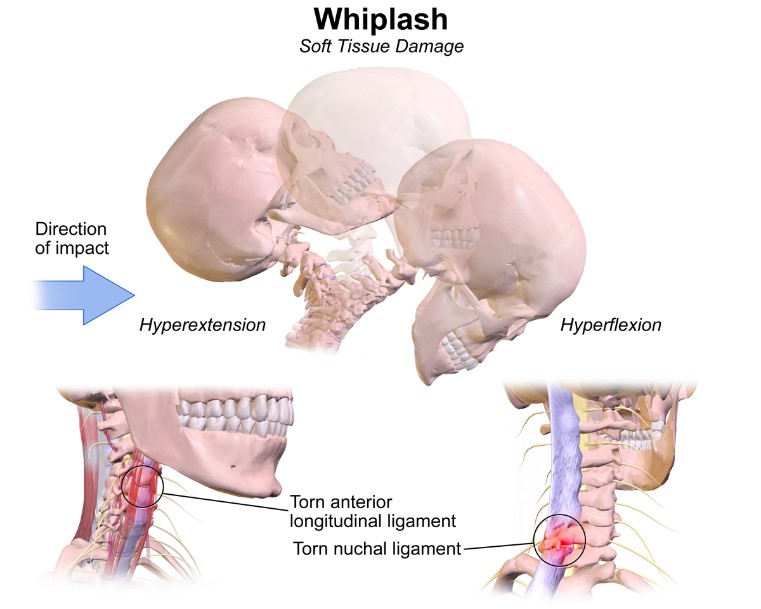 whiplash while sleeping