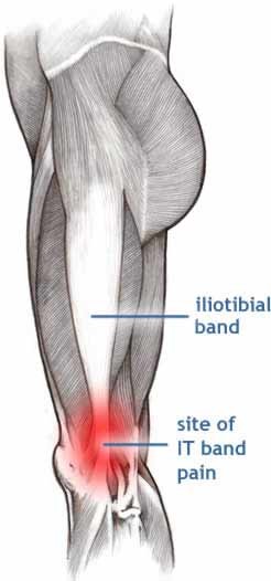 Cupping for Iliotibial Band (ITB) Syndrome