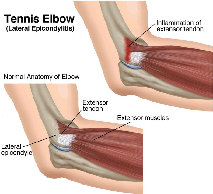 Lateral epicondyle elbow tennis extensor tendons forearm