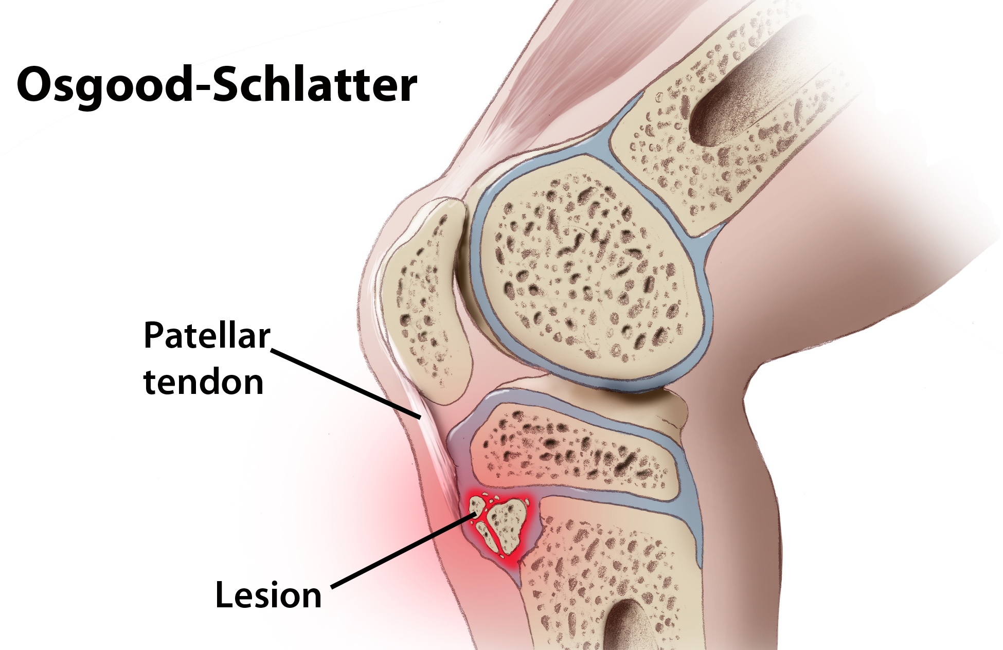 Co je Osgood Schlatter Nemoc