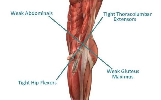 lower cross syndrome core physical therapy rehab bozeman