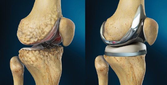 Blog | Can I Run After Total Knee Replacement?